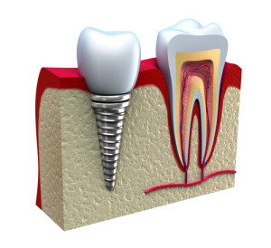 dentalimplants