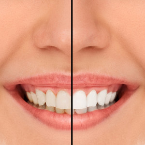 teethwhitening