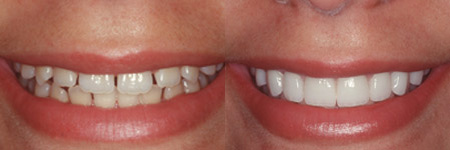 Do Dental Plans Cover Veneers?  